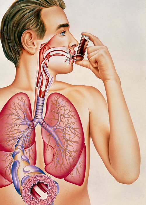 Asthma Greeting Card featuring the photograph Artwork Of Effects Of Asthma Inhaler On Man's Lung by John Bavosi