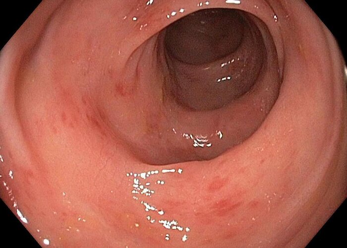 Endoscope View Greeting Card featuring the photograph Inflamed Colon From Viral Gastroenteritis by Gastrolab