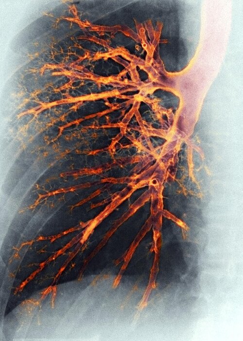 Bronciole Greeting Card featuring the photograph Lung, X-ray #1 by Cnri
