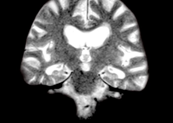 Magnetic Resonance Imaging Greeting Card featuring the photograph Mri Of Brain With Alzheimers Disease by Medical Body Scans