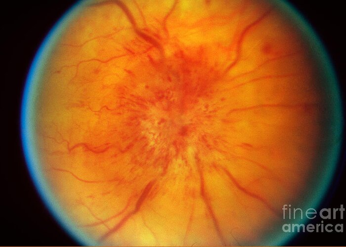 Blood Vessels Greeting Card featuring the photograph Retinal Papilledema by Science Source