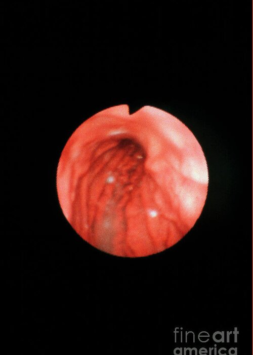 Fundus Greeting Card featuring the photograph Endoscope Image Of Normal Fundus Of Stomach #1 by Cnri/science Photo Library