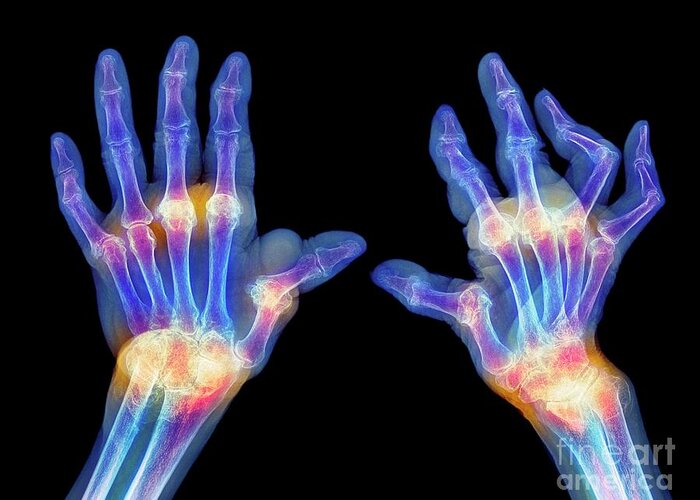 Coloured Greeting Card featuring the photograph Rheumatoid Arthritis Of The Hands #1 by Science Photo Library