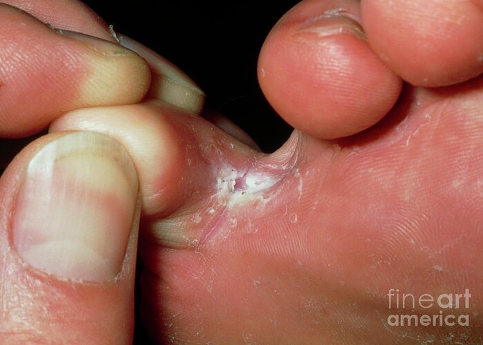 Close-up Of Athlete's Foot (tinea Pedis) Infection Greeting Card