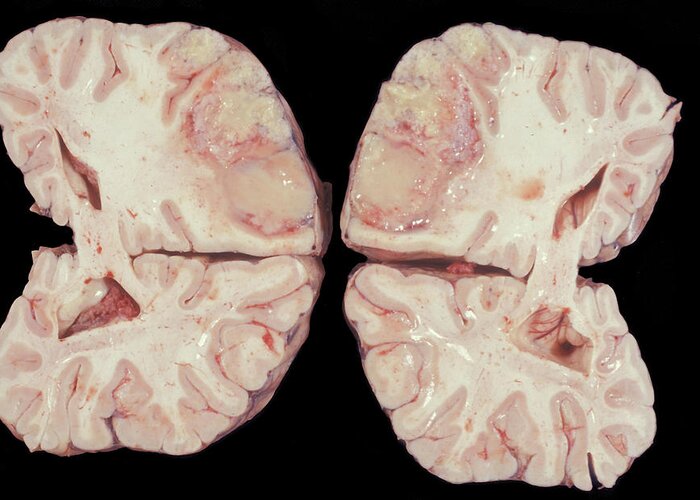 Abnormal Greeting Card featuring the photograph Human Brain Abscess by Jose Luis Calvo
