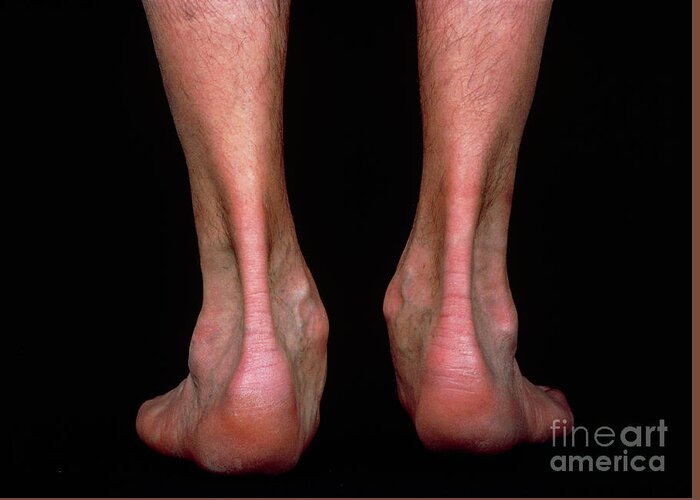 Muscle Wastage Greeting Card featuring the photograph Neurological Wasting Of Muscles In Ankles by Biophoto Associates/science Photo Library