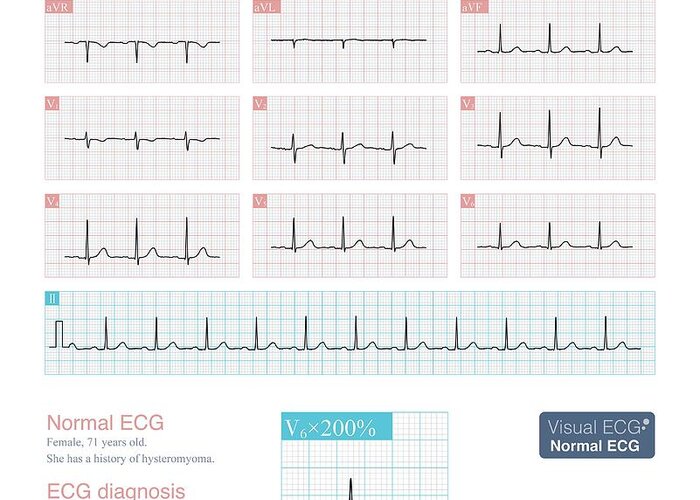 Artwork Greeting Card featuring the photograph Normal Ecg by Chongqing Tumi Technology Ltd/science Photo Library