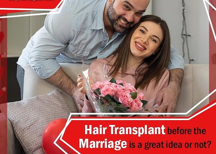 Hair Transplant Before Marriage? Ask From Hair Doctor or Hair Specialist in  Indore Greeting Card by Marmm Clinic