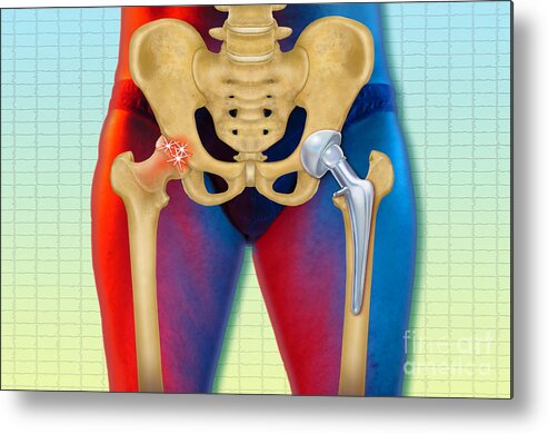 Science Metal Print featuring the photograph Arthritic And Replacement Hip by Chris Bjornberg