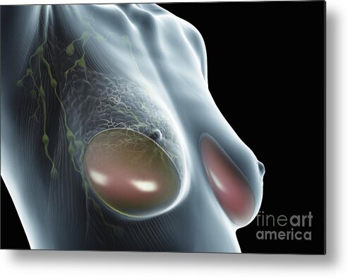 Transparent Metal Print featuring the photograph Breast Implants by Science Picture Co