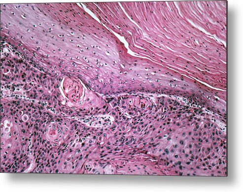 Anatomy Metal Print featuring the photograph Cutaneous Horn, Lm by Michael Abbey