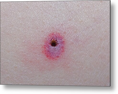 Science Metal Print featuring the photograph Deer Tick Embedded In Skin by Science Stock Photography