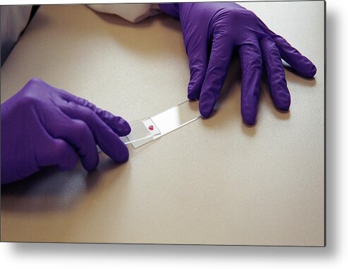 Smear Metal Print featuring the photograph Preparing Blood Smear by Sotiris Zafeiris/science Photo Library