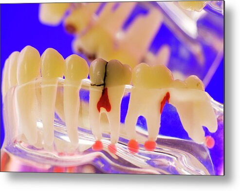 Dental Caries Metal Print featuring the photograph Tooth Disorders by Chris Knapton/science Photo Library