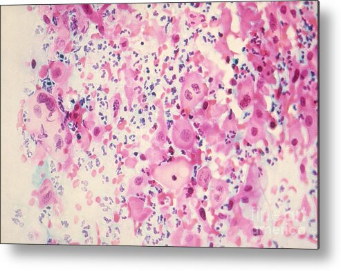 Medical Metal Print featuring the photograph Pap Smear Cancer #3 by Science Source