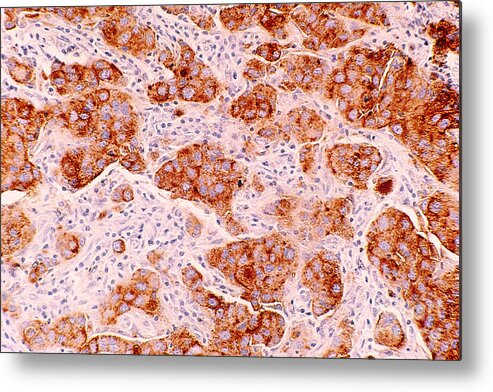 Ductal Carcinoma Metal Print featuring the photograph Ductal Carcinoma Of Human Breast by Science Source