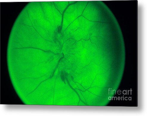 Blood Vessels Metal Print featuring the photograph Papilloedema Of The Eye by Science Source