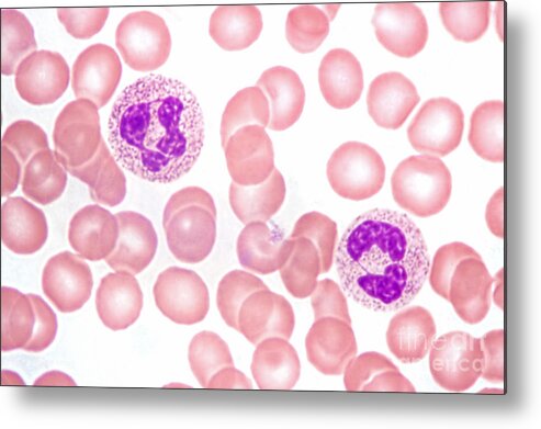 Neutrophil Polymorphs Metal Print featuring the photograph Neutrophils In Peripheral Blood Smear by M. I. Walker