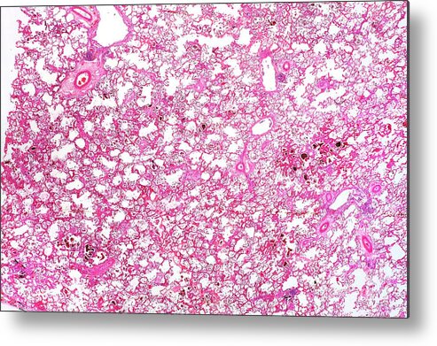 Disease Metal Print featuring the photograph Diseased Lung by Dr Keith Wheeler/science Photo Library