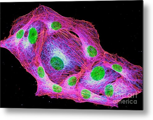 Cancer Metal Print featuring the photograph Osteosarcoma Cells Cytoskeleton And Nuclei by Howard Vindin, The University Of Sydney/science Photo Library