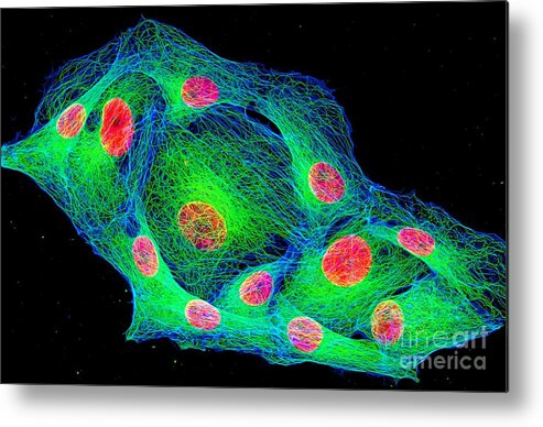 Cancer Metal Print featuring the photograph Osteosarcoma Cytoskeleton And Nuclei by Howard Vindin, The University Of Sydney/science Photo Library