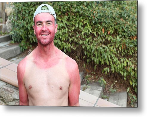 Vacations Metal Print featuring the photograph Unconscious sunburned man with horrible skin irritation by Ajr_images