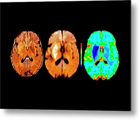 Nobody Metal Print featuring the photograph Brain In Ischemic Stroke by Zephyr
