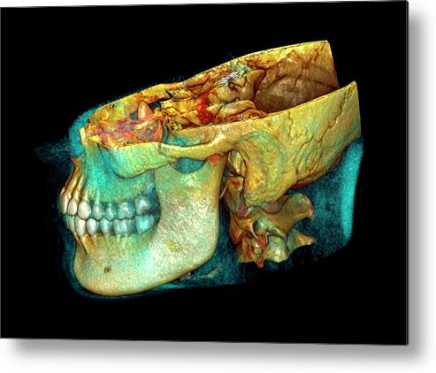 Jaw Metal Print featuring the photograph Jaw Bones by Antoine Rosset/science Photo Library