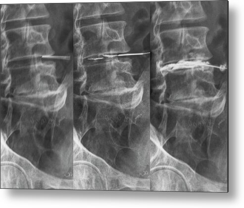 Back Metal Print featuring the photograph Sciatica Treatment by Zephyr/science Photo Library