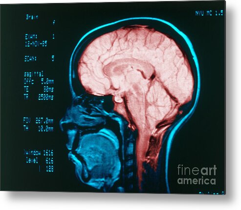 Angiography Metal Print featuring the photograph Cerebral Angiography by Science Source