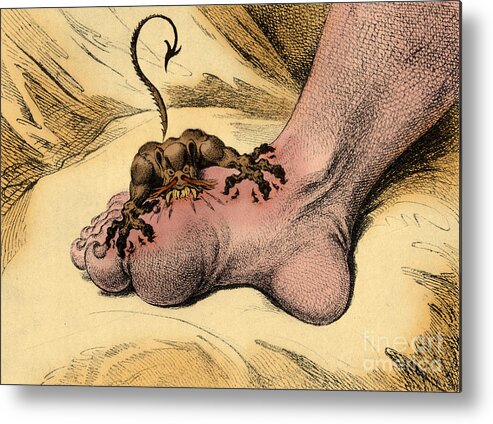 18th Century Metal Print featuring the photograph The Gout by Science Source