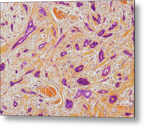 Breast Cancer Metal Print featuring the photograph Breast Cancer #28 by Steve Gschmeissner/science Photo Library