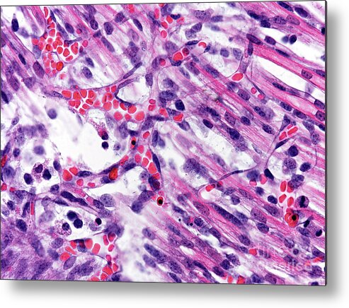 Vessel Metal Print featuring the photograph Capillaries by Microscape/science Photo Library