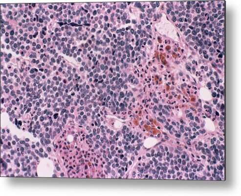 Bone Marrow Metal Print featuring the photograph Bone Marrow Cancer by Cnri/science Photo Library