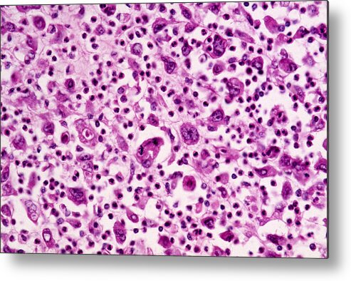 Abnormal Metal Print featuring the photograph Giant-cell Carcinoma Of The Lung, Lm by Michael Abbey