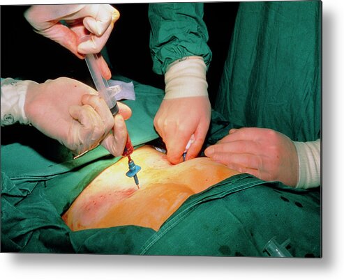 Bone Marrow Transplant Metal Print featuring the photograph Treatment Of Acute Leukaemia by Dr Rob Stepney/science Photo Library.