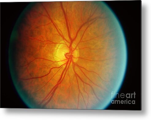 Blood Vessels Metal Print featuring the photograph Diabetic Retinopathy #2 by Science Source