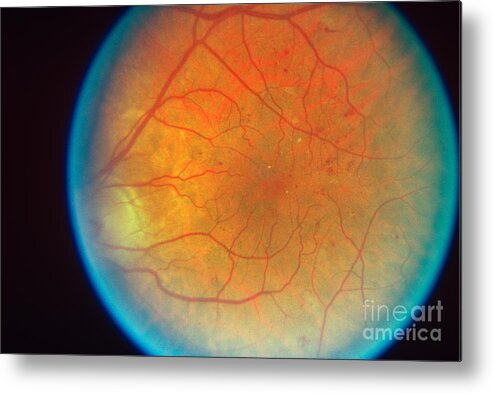 Blood Vessels Metal Print featuring the photograph Diabetes And Cataracts by Science Source