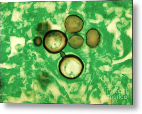 Fungus Metal Print featuring the photograph Paracoccidioides Brasiliensis by Science Source