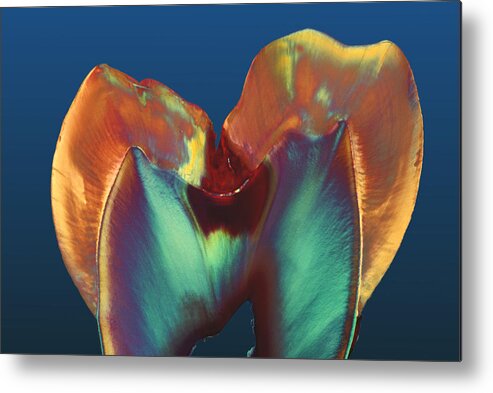 Enamel Metal Print featuring the photograph Polarised Lm Of A Molar Tooth Showing Decay by Volker Steger