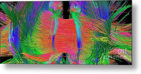 Brain Metal Print featuring the photograph Brain Fibres Front View #4 by Do Tromp/science Photo Library