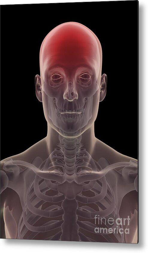 Skeletal System Metal Print featuring the photograph Head Pain #16 by Science Picture Co