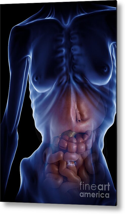 3d Model Metal Print featuring the photograph Anorexia #7 by Science Picture Co