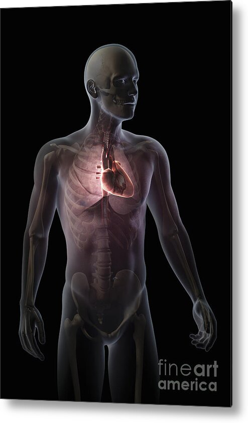 Arteries Metal Print featuring the photograph Heart Within The Chest #7 by Science Picture Co