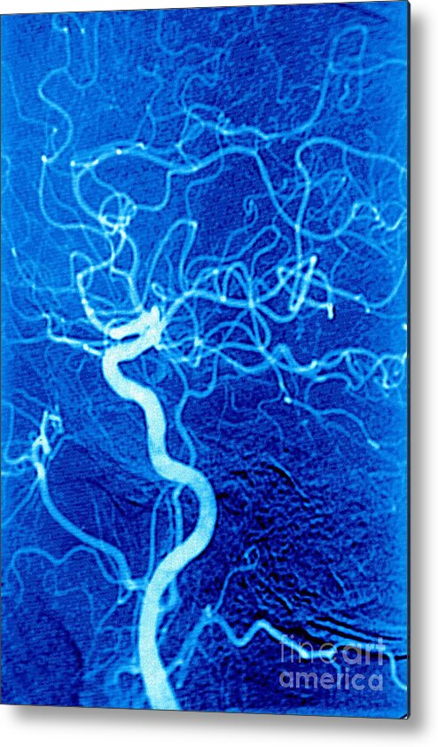 Human Metal Print featuring the photograph Carotid Angiography by James Cavallini