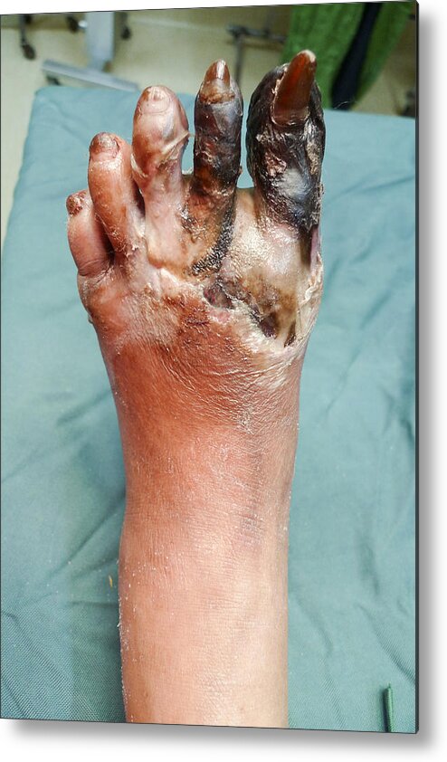Unhygienic Metal Print featuring the photograph Foot gangrene by Karl Tapales