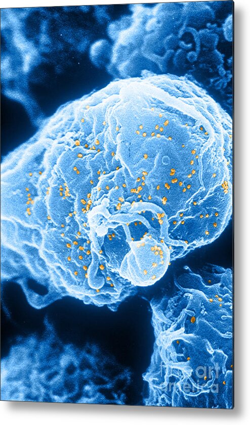 Medical Metal Print featuring the photograph Hiv-1 Infected T4 Lymphocyte Sem by Science Source
