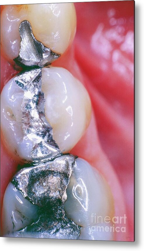 Alloy Metal Print featuring the photograph Dental Fillings by Cnri/science Photo Library