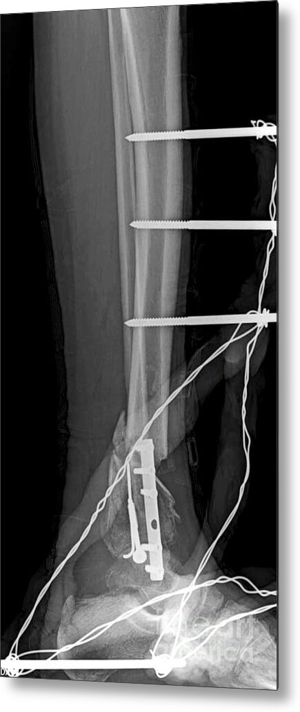 Broken Leg Metal Print featuring the photograph Tibial Fracture by Rajaaisya/science Photo Library