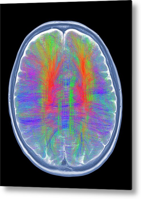 Artwork Metal Print featuring the photograph Brain Mri And White Matter Fibres #1 by Alfred Pasieka/science Photo Library